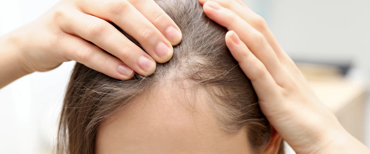 Pediculose van de hoofdhuid