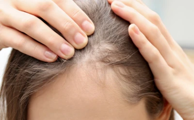 Pediculose van de hoofdhuid